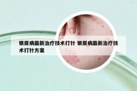 银屑病最新治疗技术打针 银屑病最新治疗技术打针方案