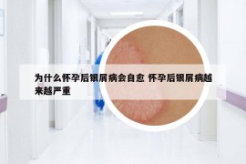 为什么怀孕后银屑病会自愈 怀孕后银屑病越来越严重