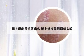 腿上爆皮是银屑病么 腿上爆皮是银屑病么吗