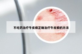 不吃药治疗牛皮癣正确治疗牛皮癣的方法