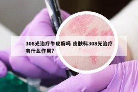 308光治疗牛皮癣吗 皮肤科308光治疗有什么作用?