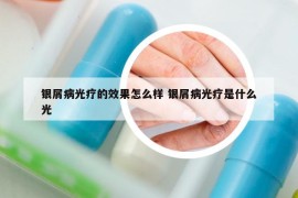 银屑病光疗的效果怎么样 银屑病光疗是什么光