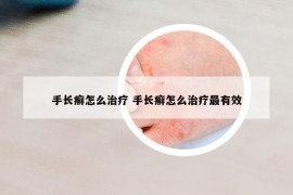 手长癣怎么治疗 手长癣怎么治疗最有效