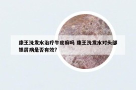 康王洗发水治疗牛皮癣吗 康王洗发水对头部银屑病是否有效?