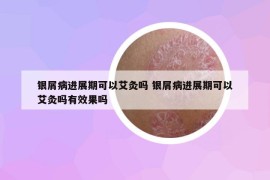 银屑病进展期可以艾灸吗 银屑病进展期可以艾灸吗有效果吗