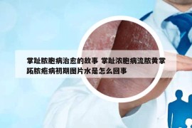 掌趾脓胞病治愈的故事 掌趾浓胞病流脓黄掌跖脓疱病初期图片水是怎么回事