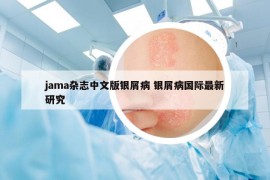 jama杂志中文版银屑病 银屑病国际最新研究