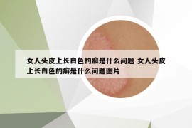 女人头皮上长白色的癣是什么问题 女人头皮上长白色的癣是什么问题图片