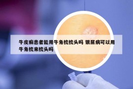 牛皮癣患者能用牛角梳梳头吗 银屑病可以用牛角梳来梳头吗