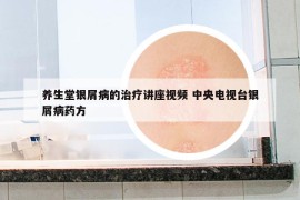 养生堂银屑病的治疗讲座视频 中央电视台银屑病药方