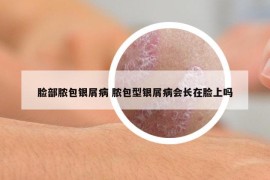 脸部脓包银屑病 脓包型银屑病会长在脸上吗