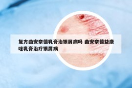 复方曲安奈德乳膏治银屑病吗 曲安奈德益康唑乳膏治疗银屑病