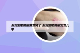 点滴型银屑病爆发完了 点滴型银屑病复发几率