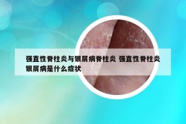 强直性脊柱炎与银屑病脊柱炎 强直性脊柱炎银屑病是什么症状