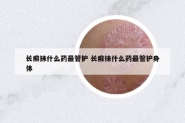 长癣抹什么药最管护 长癣抹什么药最管护身体