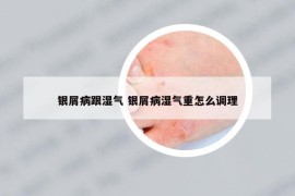 银屑病跟湿气 银屑病湿气重怎么调理