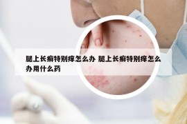 腿上长癣特别痒怎么办 腿上长癣特别痒怎么办用什么药