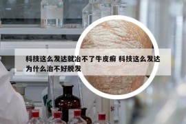 科技这么发达就冶不了牛皮癣 科技这么发达为什么治不好脱发