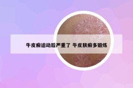 牛皮癣运动后严重了 牛皮肤癣多锻炼