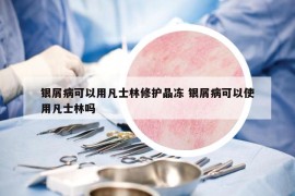 银屑病可以用凡士林修护晶冻 银屑病可以使用凡士林吗