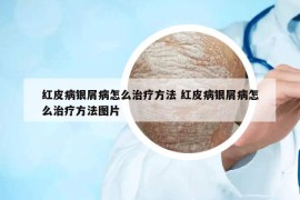 红皮病银屑病怎么治疗方法 红皮病银屑病怎么治疗方法图片