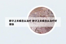 脖子上长癣怎么治疗 脖子上长癣怎么治疗好得快