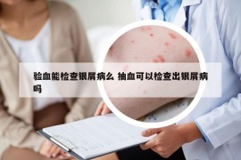 验血能检查银屑病么 抽血可以检查出银屑病吗