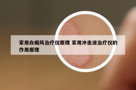 家用白癜风治疗仪原理 家用冲击波治疗仪的作用原理