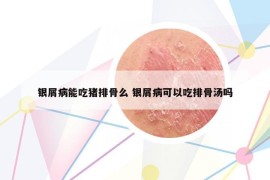 银屑病能吃猪排骨么 银屑病可以吃排骨汤吗