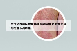 白斑和白癜风在伍德灯下的区别 白斑在伍德灯检查下亮白色