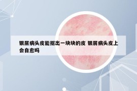 银屑病头皮能抠出一块块的皮 银屑病头皮上会自愈吗