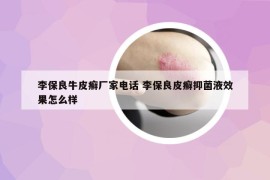 李保良牛皮癣厂家电话 李保良皮癣抑菌液效果怎么样