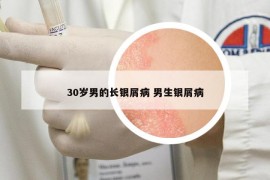 30岁男的长银屑病 男生银屑病