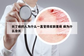 长了癣的人为什么一直觉得皮肤里痒 癣为什么会长