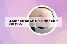 小孩脸上有白癣怎么回事 小孩子脸上有白色的癣怎么办