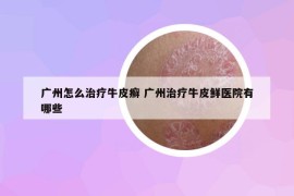 广州怎么治疗牛皮癣 广州治疗牛皮鲜医院有哪些