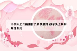 小孩头上长癣用什么药物最好 孩子头上长癣用什么药