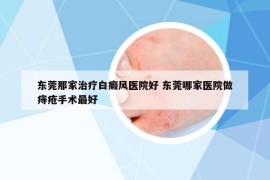 东莞那家治疗白癜风医院好 东莞哪家医院做痔疮手术最好