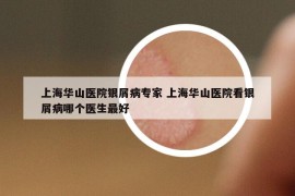 上海华山医院银屑病专家 上海华山医院看银屑病哪个医生最好