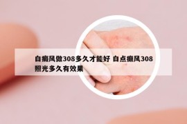 白癜风做308多久才能好 白点癫风308照光多久有效果