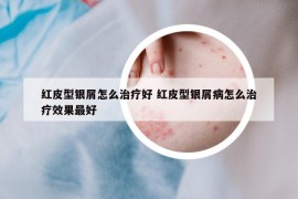 红皮型银屑怎么治疗好 红皮型银屑病怎么治疗效果最好