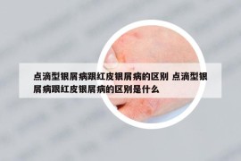 点滴型银屑病跟红皮银屑病的区别 点滴型银屑病跟红皮银屑病的区别是什么