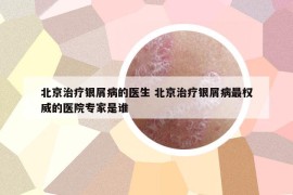 北京治疗银屑病的医生 北京治疗银屑病最权威的医院专家是谁