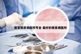 那家银屑病医院专业 最好的银屑病医院