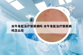 水牛角能治疗银屑病吗 水牛角能治疗银屑病吗怎么吃