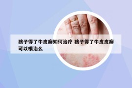 孩子得了牛皮癣如何治疗 孩子得了牛皮皮癣可以根治么