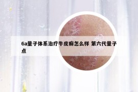 6a量子体系治疗牛皮癣怎么样 第六代量子点