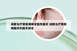 成都治疗银屑病哪家医院最好 成都治疗银屑病最好的医生排名