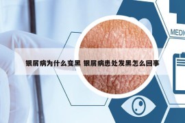 银屑病为什么变黑 银屑病患处发黑怎么回事