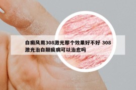 白癜风用308激光那个效果好不好 308激光治白颠疯病可以治愈吗